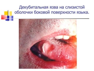 Декубитальная язва на слизистой оболочки боковой поверхности языка. 