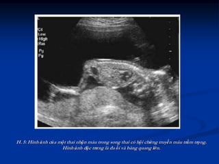 H. 5: Hình ảnh của một thai nhận máu trong song thai có hội chứng truyền máu trầm trọng.
                    Hình ảnh đặc trưng là đa ối và bàng quang lớn.
 