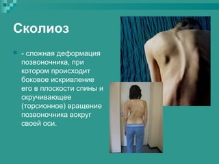 Сколиоз


- сложная деформация
позвоночника, при
котором происходит
боковое искривление
его в плоскости спины и
скручивающее
(торсионное) вращение
позвоночника вокруг
своей оси.

 