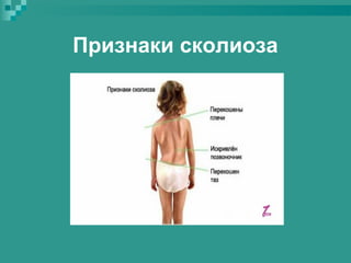 Признаки сколиоза

 