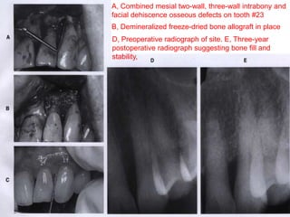 A, Combined mesial two-wall, three-wall intrabony and
facial dehiscence osseous defects on tooth #23
B, Demineralized freeze-dried bone allograft in place
D, Preoperative radiograph of site. E, Three-year
postoperative radiograph suggesting bone fill and
stability,
 