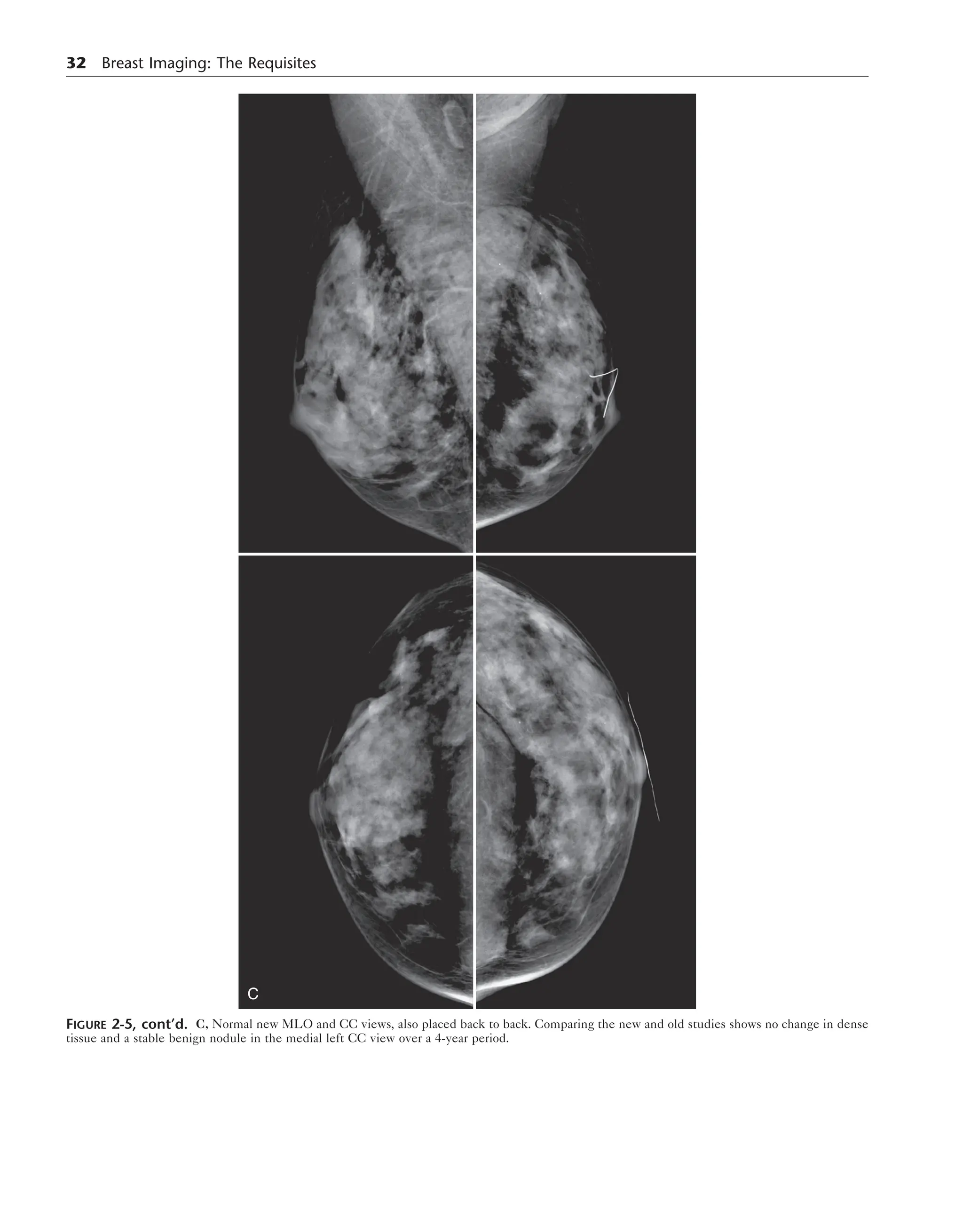 Breast Imaging The Requisites 2nd Edition Debra Ikeda Md | PDF