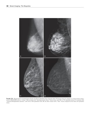 Breast Imaging The Requisites 2nd Edition Debra Ikeda Md | PDF