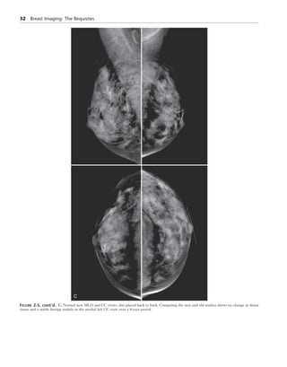 Breast Imaging The Requisites 2nd Edition Debra Ikeda Md | PDF