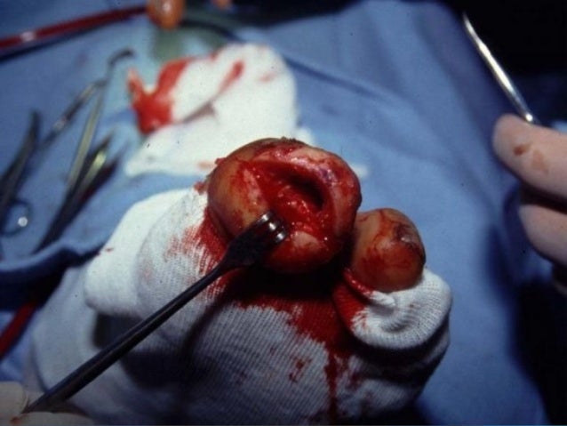 Partial Foot Amputations And Toe Fillers Shoes Partial Foot Amputations And Toe Fillers Shoes