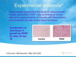 Experimental evidence*
• These results suggest that the levels of various growth
factors, particularly PDGF, may be limiting at wound
sites and supplementation of wounds with these factors
can accelerate the rate of new tissue formation.
Acceleration of
new tissue in
growth by PDGF
(in rats). At day
10
*J Clin Invest. 1985 December; 76(6): 2323–2329
Control PDGF
 