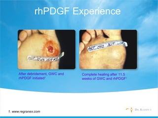 rhPDGF Experience
Complete healing after 11.5
weeks of GWC and rhPDGF1
After debridement, GWC and
rhPDGF initiated1
1. www.regranex.com
 