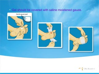 • Gel should be covered with saline moistened gauze.
 