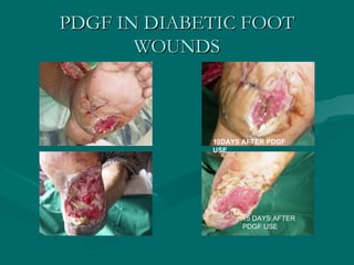 PDGF IN DIABETIC FOOTPDGF IN DIABETIC FOOT
WOUNDSWOUNDS
10DAYS AFTER PDGF
USE
15 DAYS AFTER
PDGF USE
 