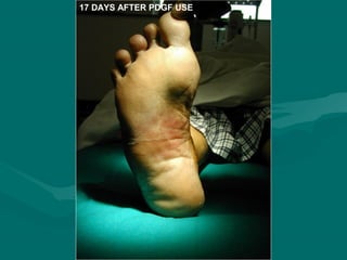 17 DAYS AFTER PDGF USE
 