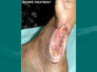 BEFORE TREATMENT
 