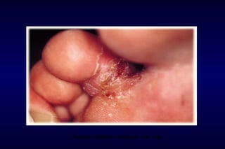 Fungal infection between the toes
 