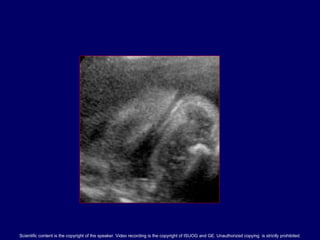 Fetal Anus Sonographic Visualisation - Dr.S.Boopathy Vijayaraghavan