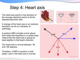 Step 4: Heart axis
The heart axis points in the direction of
the average electrical vector of all the
depolarizing heart cells.

A change of the heart axis or an extreme
deviation can be an indication of
pathology.

A positive QRS complex (more above
than below the baseline) in a certain lead
means that the heart axis is going (at
least slightly) in that lead's direction.

The heart axis is normal between -30
and +90 degrees.

Therefore, if QRS is positive in both
leads I and II, the heart axis is normal.
 