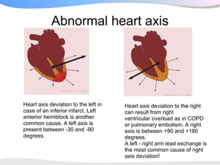 Abnormal heart axis




Heart axis deviation to the left in   Heart axis deviation to the right
case of an inferior infarct. Left     can result from right
anterior hemiblock is another         ventricular overload as in COPD
common cause. A left axis is          or pulmonary embolism. A right
present between -30 and -90           axis is between +90 and +180
degrees.                              degrees.
                                      A left - right arm lead exchange is
                                      the most common cause of right
                                      axis deviation!
 