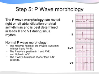 Step 5: P Wave morphology
The P wave morphology can reveal                    I
right or left atrial dilatation or atrial
arrhythmias and is best determined
in leads II and V1 during sinus
rhythm.                                            II


Normal P wave morphology :
•   The maximal height of the P wave is 2.5 mm
    in leads II and / or III.                    AVF
•   The P wave is positive in II and AVF,
     and biphasic in V1.
•   The P wave duration is shorter than 0.12
    seconds.
                                                  V1
 