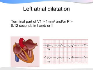 Left atrial dilatation

Terminal part of V1 > 1mm2 and/or P >
0.12 seconds in I and/ or II
 