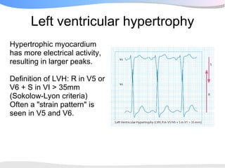 Left ventricular hypertrophy
Hypertrophic myocardium
has more electrical activity,
resulting in larger peaks.

Definition of LVH: R in V5 or
V6 + S in VI > 35mm
(Sokolow-Lyon criteria)
Often a "strain pattern" is
seen in V5 and V6.
 