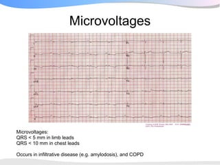 Microvoltages




Microvoltages:
QRS < 5 mm in limb leads
QRS < 10 mm in chest leads

Occurs in infiltrative disease (e.g. amylodosis), and COPD
 
