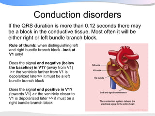 Conduction disorders
If the QRS duration is more than 0.12 seconds there may
be a block in the conductive tissue. Most often it will be
either right or left bundle branch block.
Rule of thumb: when distinguishing left
and right bundle branch block--look at
V1 only!

Does the signal end negative (below
the baseline) in V1? (away from V1)
 >> the ventricle farther from V1 is
depolarized later>> it must be a left
bundle branch block

Does the signal end positive in V1?
(towards V1) >> the ventricle closer to
V1 is depolarized later >> it must be a
right bundle branch block
 