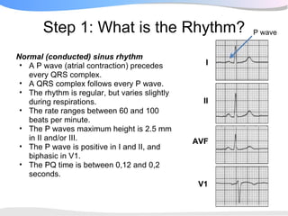 Step 1: What is the Rhythm?                     P wave


Normal (conducted) sinus rhythm
 • A P wave (atrial contraction) precedes          I
   every QRS complex.
 • A QRS complex follows every P wave.
 • The rhythm is regular, but varies slightly
   during respirations.                           II
 • The rate ranges between 60 and 100
   beats per minute.
 • The P waves maximum height is 2.5 mm
   in II and/or III.                            AVF
 • The P wave is positive in I and II, and
   biphasic in V1.
 • The PQ time is between 0,12 and 0,2
   seconds.
                                                 V1
 