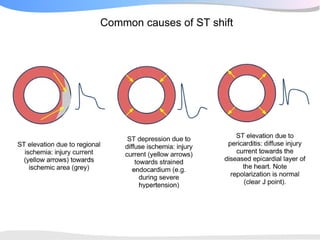 Common causes of ST shift
 