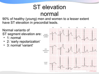 ST elevation
                       normal
90% of healthy (young) men and women to a lesser extent
have ST elevation in precordial leads.

Normal variants of
ST segment elevation are:
• 1: normal
• 2: ‘early repolarization’
• 3: normal 'variant'
 