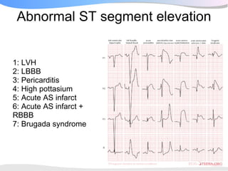 Abnormal ST segment elevation


1: LVH
2: LBBB
3: Pericarditis
4: High pottasium
5: Acute AS infarct
6: Acute AS infarct +
RBBB
7: Brugada syndrome
 