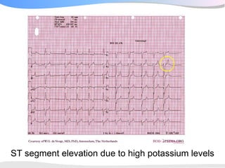 ST segment elevation due to high potassium levels
 