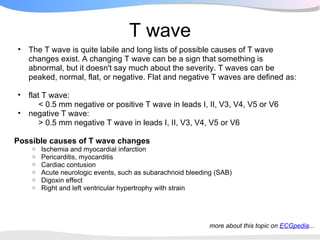 T wave
•   The T wave is quite labile and long lists of possible causes of T wave
    changes exist. A changing T wave can be a sign that something is
    abnormal, but it doesn't say much about the severity. T waves can be
    peaked, normal, flat, or negative. Flat and negative T waves are defined as:

•   flat T wave:
        < 0.5 mm negative or positive T wave in leads I, II, V3, V4, V5 or V6
•   negative T wave:
        > 0.5 mm negative T wave in leads I, II, V3, V4, V5 or V6

Possible causes of T wave changes
     o   Ischemia and myocardial infarction
     o   Pericarditis, myocarditis
     o   Cardiac contusion
     o   Acute neurologic events, such as subarachnoid bleeding (SAB)
     o   Digoxin effect
     o   Right and left ventricular hypertrophy with strain




                                                             more about this topic on ECGpedia...
 