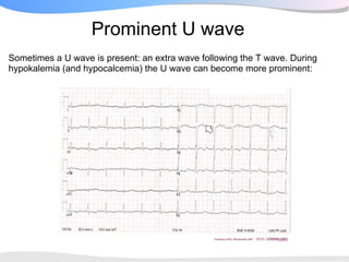 Prominent U wave
Sometimes a U wave is present: an extra wave following the T wave. During
hypokalemia (and hypocalcemia) the U wave can become more prominent:
 