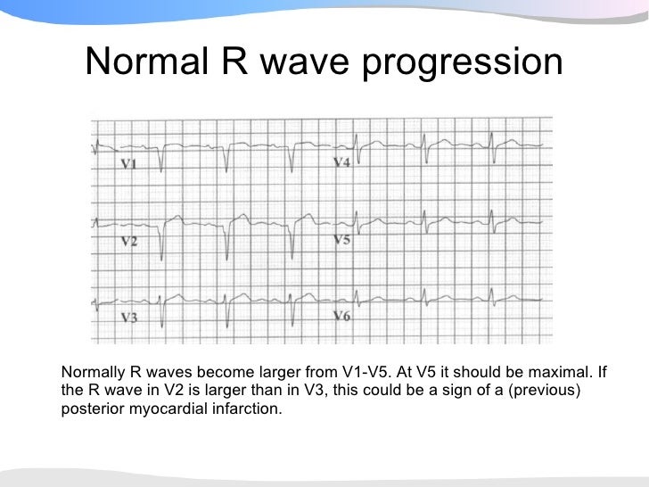ecgpedia ecg presentation