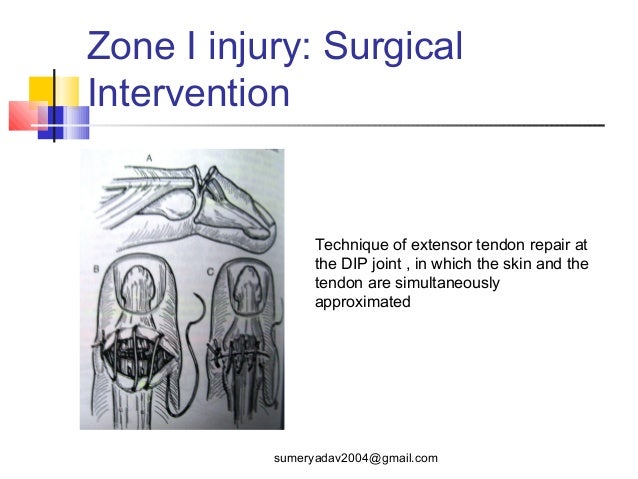 extensor tendons injury and deformity