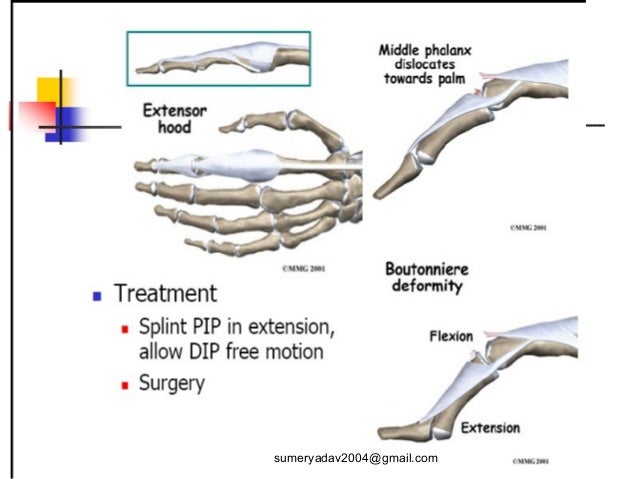 extensor tendons injury and deformity