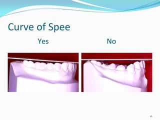 Curve of Spee
      Yes                                No




                                              16
 