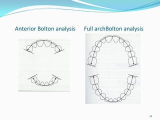 Anterior Bolton analysis      Full archBolton analysis




                                                         28
 