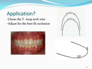 Application? 
•Chose the T –loop arch wire 
•Adjust for the best fit occlusion




                                     30
 