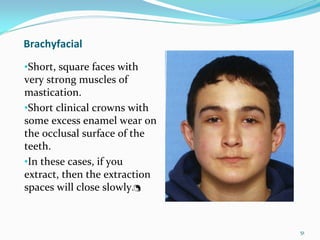 Brachyfacial
•Short, square faces with 
very strong muscles of 
mastication.
•Short clinical crowns with 
some excess enamel wear on 
the occlusal surface of the 
teeth. 
•In these cases, if you 
extract, then the extraction 
spaces will close slowly. 



                                51
 