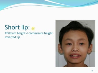 Short lip: @
Philtrum height < commisure height 
Inverted lip




                                      58
 