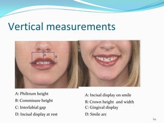 Vertical measurements




 A: Philtrum height           A: Incisal display on smile
 B: Commisure height          B: Crown height  and width
 C: Interlabial gap           C: Gingival display 
 D: Incisal display at rest   D: Smile arc
                                                            69
 
