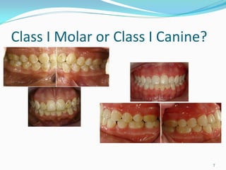Class I Molar or Class I Canine?




                                   7
 