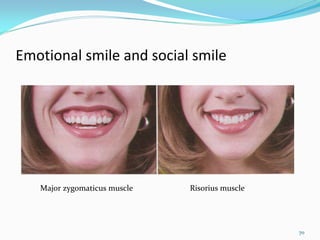 Emotional smile and social smile




   Major zygomaticus muscle   Risorius muscle




                                                70
 