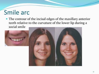 Smile arc
 The contour of the incisal edges of the maxillary anterior 
 teeth relative to the curvature of the lower lip during a 
 social smile




                                                               71
 