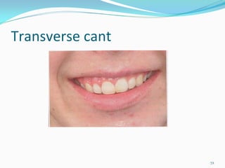 Transverse cant




                  72
 