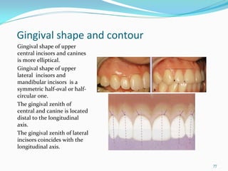 Gingival shape and contour
Gingival shape of upper 
central incisors and canines 
is more elliptical.
Gingival shape of upper 
lateral  incisors and 
mandibular incisors  is a 
symmetric half‐oval or half‐
circular one.
The gingival zenith of 
central and canine is located 
distal to the longitudinal 
axis. 
The gingival zenith of lateral 
incisors coincides with the 
longitudinal axis. 


                                  77
 
