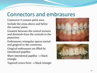 Connectors and embrasures
Connector # contact point area:
Include the areas above and below 
the contact point.
Greatest between the central incisors 
and diminish from the centrals to the 
posteriors. 
Embrasures: triangular spaces incisal
and gingival to the connector. 
Gingival embrasures are filled by 
interdental papillae. 
Short interdental papillae → black 
triangle. 
Tapered crown form → black triangle

                                         78
 