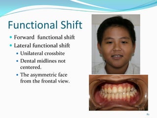 Functional Shift
 Forward  functional shift
 Lateral functional shift 
   Unilateral crossbite
   Dental midlines not 
   centered.
   The asymmetric face 
   from the frontal view.




                             82
 