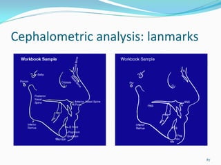 Cephalometric analysis: lanmarks




                                   87
 