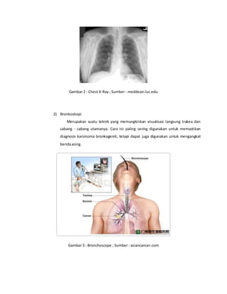Gambar 2 : Chest X-Ray ; Sumber : meddean.luc.edu
2) Bronkoskopi
Merupakan suatu teknik yang memungkinkan visualisasi langsung trakea dan
cabang - cabang utamanya. Cara ini paling sering digunakan untuk memastikan
diagnosis karsinoma bronkogenik, tetapi dapat juga digunakan untuk mengangkat
bendaasing.
Gambar 3 : Bronchoscope ; Sumber : asiancancer.com
 