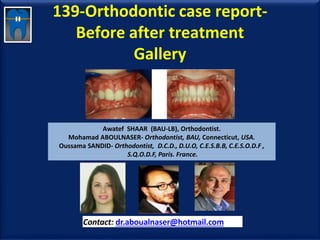 139-Orthodontic case report-
Before after treatment
Gallery
Awatef SHAAR (BAU-LB), Orthodontist.
Mohamad ABOULNASER- Orthodontist, BAU, Connecticut, USA.
Oussama SANDID- Orthodontist, D.C.D., D.U.O, C.E.S.B.B, C.E.S.O.D.F ,
S.Q.O.D.F, Paris. France.
Contact: dr.aboualnaser@hotmail.com
www.orthofree.com
 